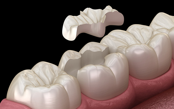 AESTHETIC DENTAL FILLINGS