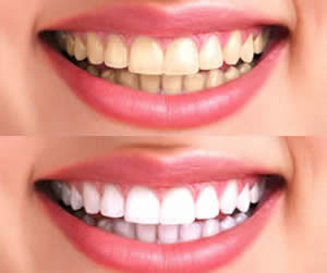 TEETH WHITENING