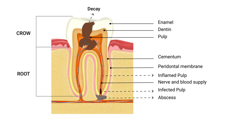 ROOT CANAL TREATMENT